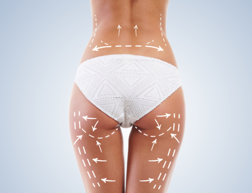 How to keep cellulite off after Lipofirm treatment