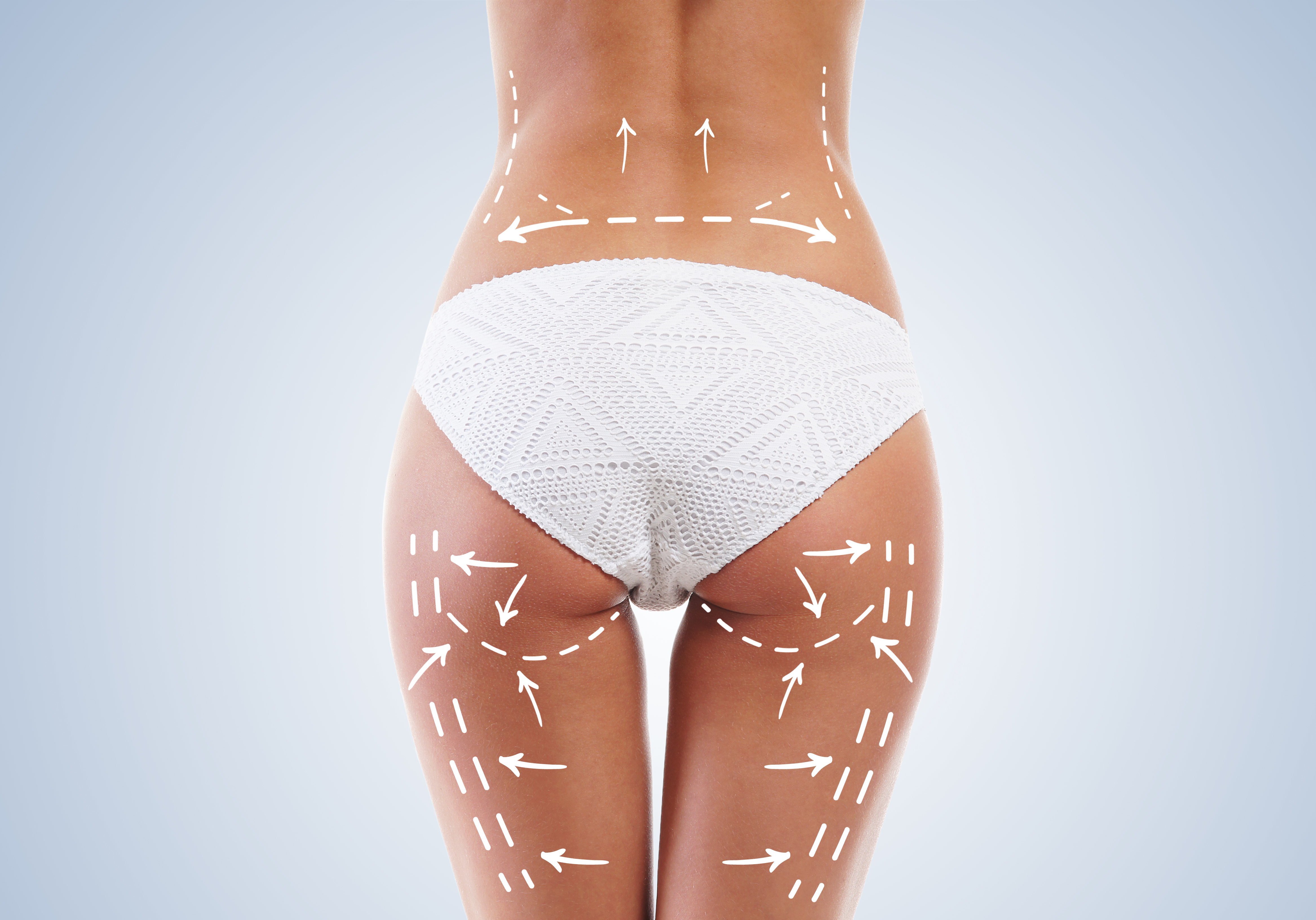 Beautiful legs with arrows on hips. Plastic surgery concept. Lipofirm Pro treatments Forest Hill