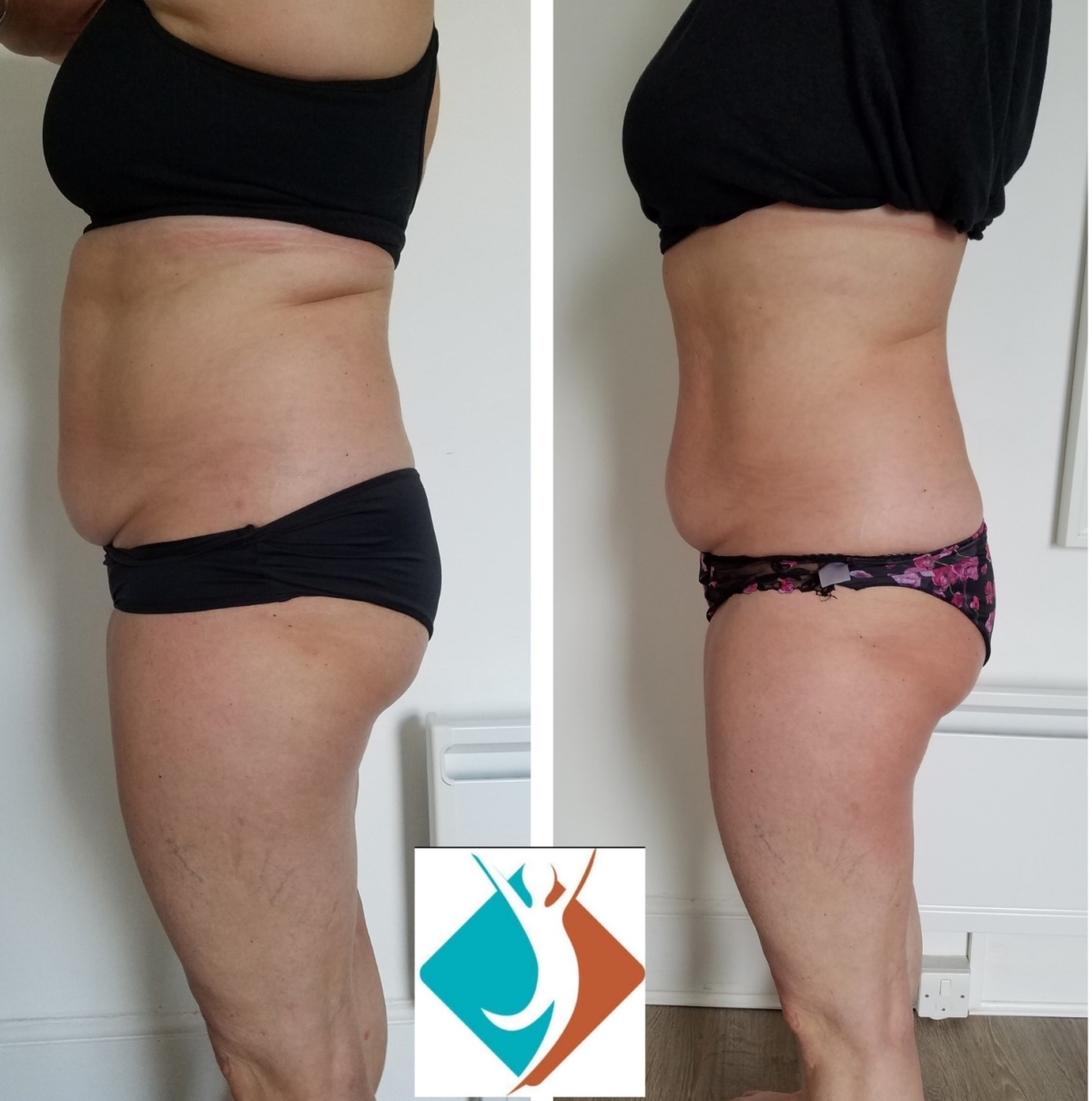 Non Surgical fat reduction. Body contouring treatments in Croydon