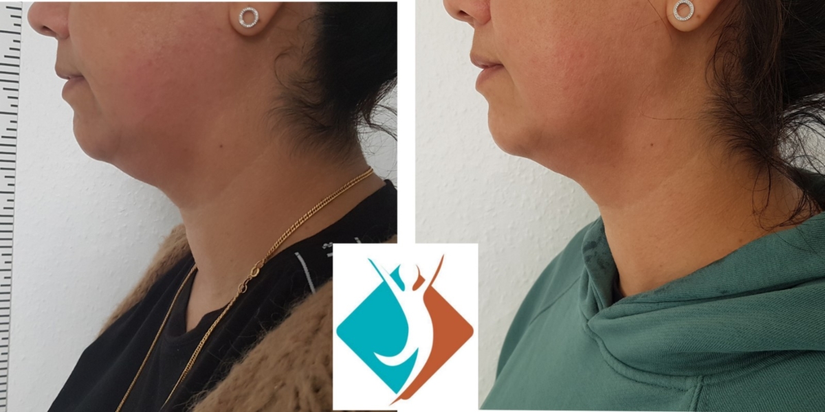 NonSurgical Facelift & Jaw Lift in Croydon, South London