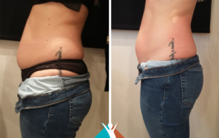 Body fat reduction in Addiscombe