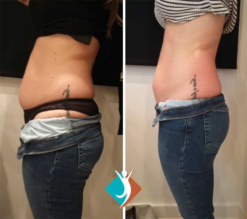 Body fat reduction in Addiscombe