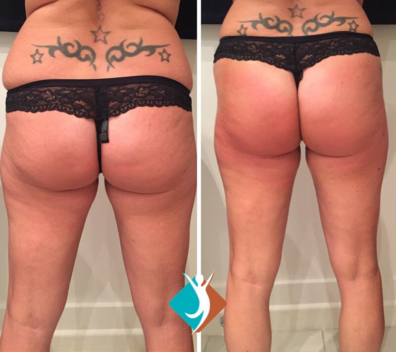 before-and-after-15 (1)