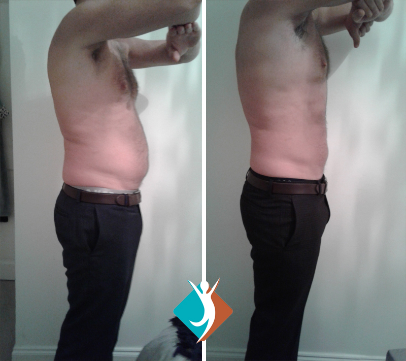 fat reduction in Addiscombe