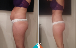 Proven results with Shape and Tone Aesthetics - reduce body fat in Croydon