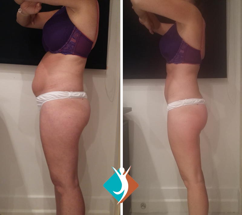 before-and-after-5 Proven results with Shape and Tone Aesthetics - reduce body fat in Croydon