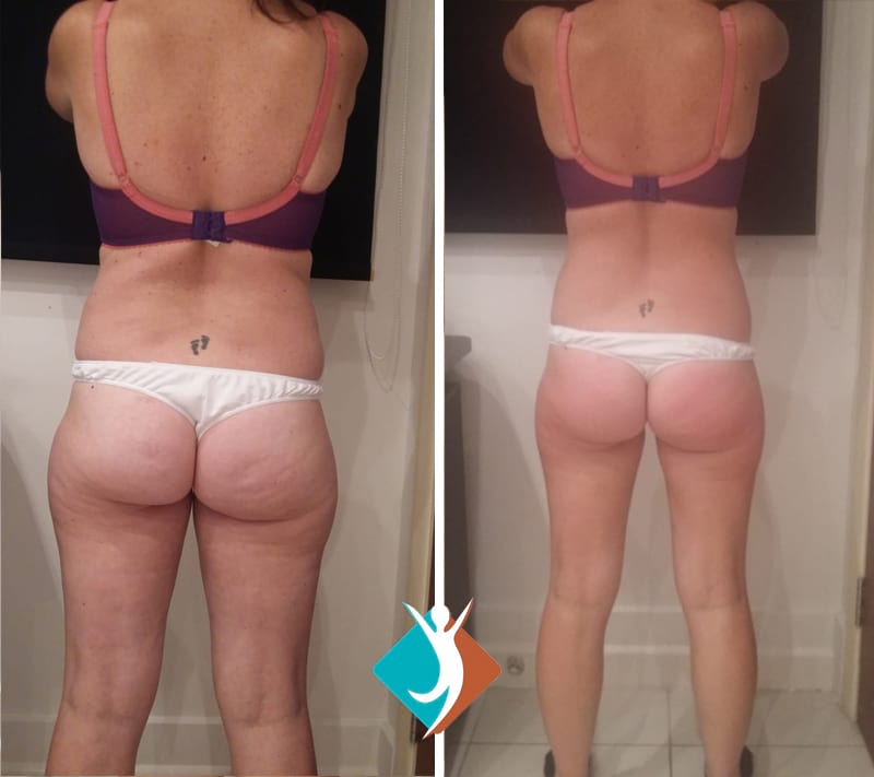 Cellulite treatment Thornton Heath