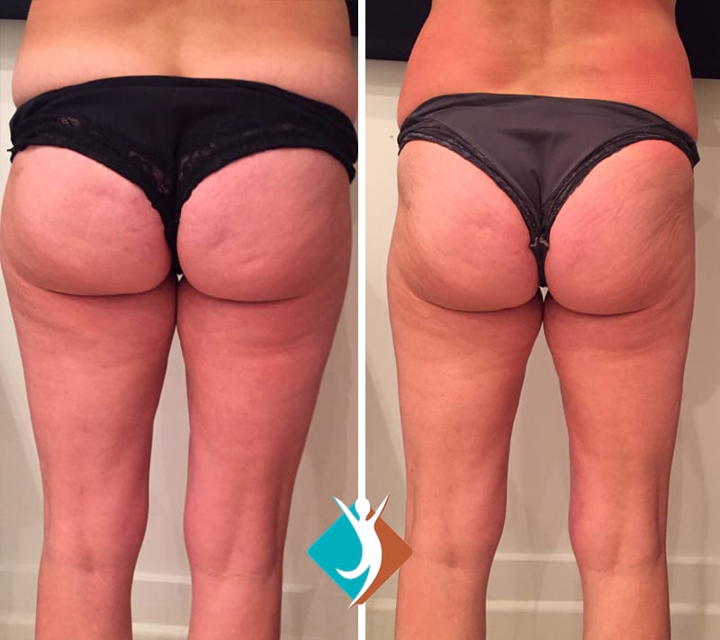Proven fat reduction and cellulite reduction in Croydon