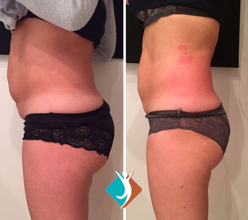 Reduce Flank Fat at Woburn, MA