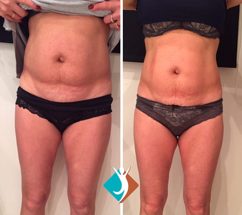 lipoform-croydon-case-study-04 Fat reduction in Croydon